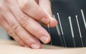 Akupunktur Bisa Menurunkan Tekanan Darah Pasien Hipertensi