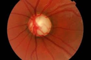 Gambaran Mata Terkena Glaukoma